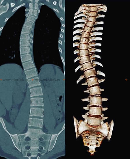 Idiopathic scoliosis is diagnosed by computed tomography of the spine (CT).